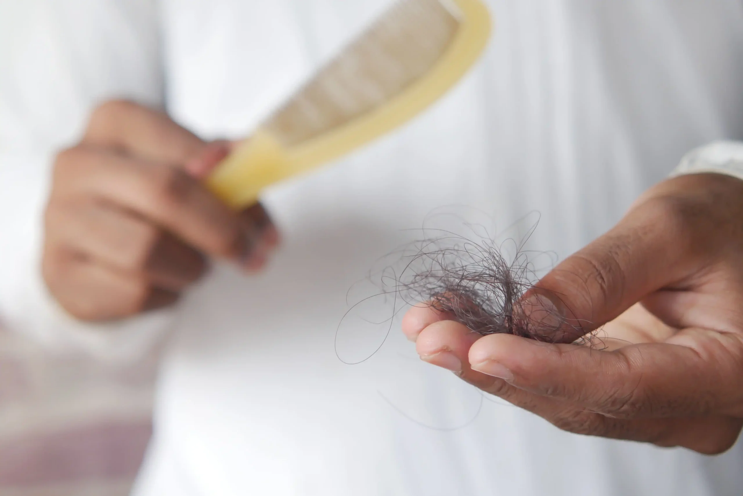 Minoxidil vs Finasteride comparison for hair loss, showing excessive hair shedding collected in a person's hand after brushing.